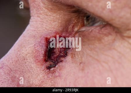 Un primo piano di un carcinoma basale sulla pelle del viso vicino all'occhio Foto Stock