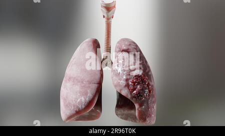 Polmonite malattia, polmoni sani e polmoni malattia, cancro polmonare umano, fumatori di sigaretta malattia polmonare, tumori maligni cancerosi in crescita e spreadina Foto Stock