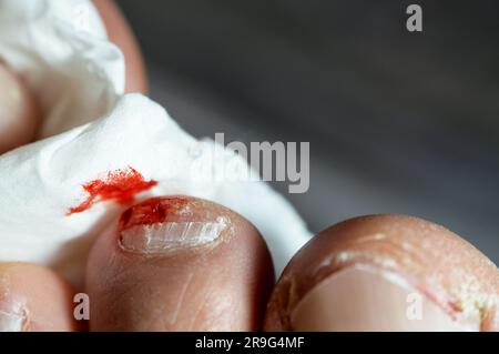 Sanguinamento sulla punta del secondo dito del piede sinistro, insulto del piede del piede che causa una ferita sanguinante che richiede cura e benda, sangue sul dito del piede Foto Stock