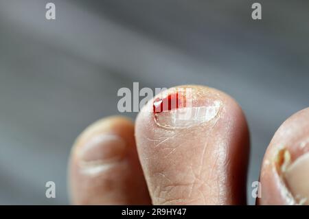 Sanguinamento sulla punta del secondo dito del piede sinistro, insulto del piede del piede che causa una ferita sanguinante che richiede cura e benda, sangue sul dito del piede Foto Stock