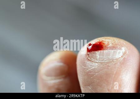 Sanguinamento sulla punta del secondo dito del piede sinistro, insulto del piede del piede che causa una ferita sanguinante che richiede cura e benda, sangue sul dito del piede Foto Stock