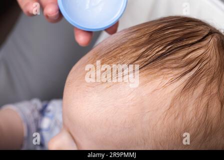 Applicare una crema e un olio speciali al cuoio capelluto del bambino per rimuovere gli sneiss o la crosta seborroica. Scale gialle sul cuoio capelluto. Foto Stock