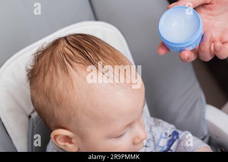 Applicare una crema e un olio speciali al cuoio capelluto del bambino per rimuovere gli sneiss o la crosta seborroica. Scale gialle sul cuoio capelluto. Foto Stock