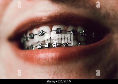 Buon primo piano di un giovane adulto con l'apparecchio Foto Stock