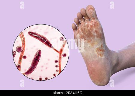 Athlete's foot, illustration Stock Photo