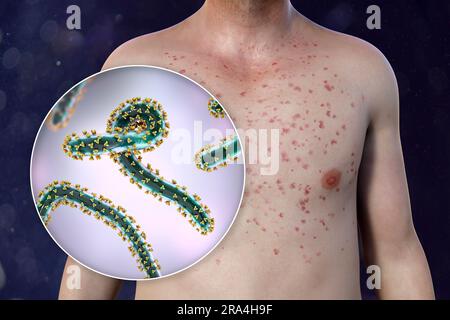 Eruzione cutanea nella febbre emorragica di Marburg, illustrazione Foto Stock
