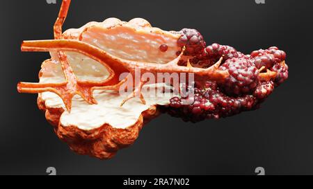 Malattia pancreatica, ghiandola digestiva, diagramma anatomico del cancro del pancreas umano, medico accurato, crescita e diffusione del tumore maligno, cellule mutanti, Foto Stock