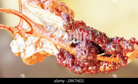 Malattia pancreatica, ghiandola digestiva, diagramma anatomico del cancro del pancreas umano, medico accurato, crescita e diffusione del tumore maligno, cellule mutanti, Foto Stock