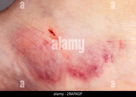 Primo piano sul livido sulla pelle della gamba di una donna ferita. Foto Stock