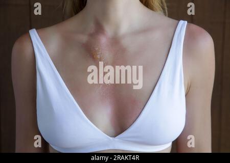 Ustione di secondo grado con vescica sul petto della donna Foto Stock