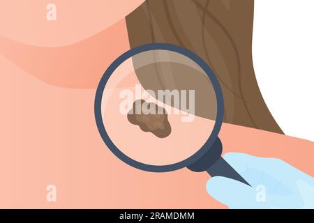 controlli medici mole sotto lente di ingrandimento; melanoma prevenzione del cancro della pelle - illustrazione vettoriale Illustrazione Vettoriale
