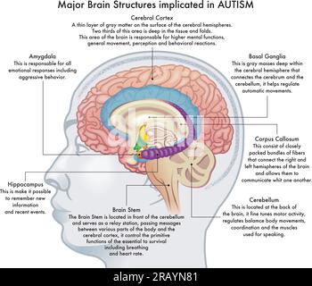 Illustrazione medica che mostra le principali strutture cerebrali implicate nel disturbo dello spettro autistico, con annotazioni. Illustrazione Vettoriale