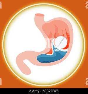 Trattamento con bruciore di stomaco. Illustrazione della pillola antiacida che allevia l'indigestione acida nello stomaco su sfondo colorato. Fiamma come sensazione di bruciore e acqua come h Foto Stock