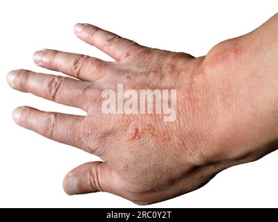 Ustioni chimiche della pelle causate da alghe. La mano dell'uomo ha sofferto di pericolose ustioni di piante note come pastinache di mucca o prezzemolo di mucca gigante - il palmo è acceso Foto Stock