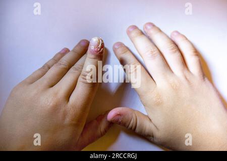 Dito gonfio con infiammazione dovuta a infezione da unghie strappate Foto Stock