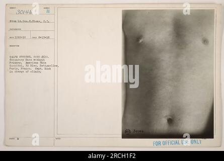 Immagine di soldati americani in cura presso l'American Skin Hospital di Parigi, Francia durante la prima guerra mondiale. Il capitano Mook è a capo della clinica. La data della fotografia è il 15 agosto 1918. La fotografia è rilasciata da Ralph Stevens con la designazione ufficiale #601. Foto Stock