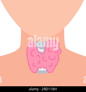 Ingrossamento della ghiandola tiroidea sul profilo del collo Illustrazione Vettoriale