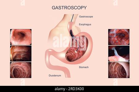 Endoscopia digestiva o gastroscopia. Esecuzione di una procedura di gastroscopia. Diagnosi di malattie gastriche. Salute dello stomaco. Concetto medico Foto Stock