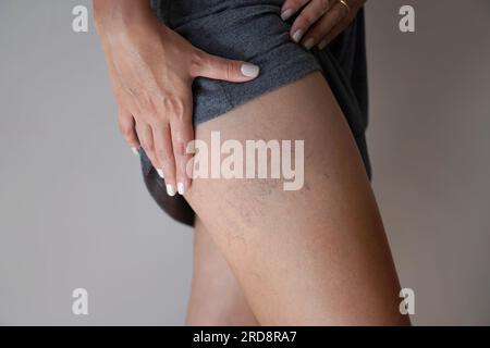 Vene varicose sulle gambe delle donne Foto Stock