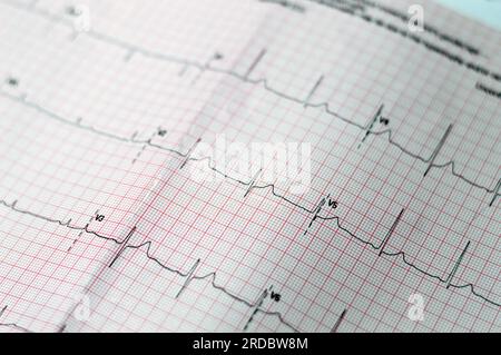 Carta per elettrocardiografo ECG che mostra anomalie del ritmo sinusale dell'ipertrofia ventricolare destra, onda T inferiore a causa di ipertrofia e ischemia, Ab Foto Stock