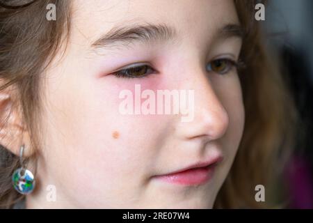 Una palpebra rossa gonfia sul viso di un bambino in primo piano è un'allergia al morso di un insetto. Reazione allergica agli insetti succhiatori di sangue Foto Stock