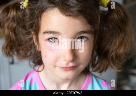 Una palpebra rossa gonfia sul viso di un bambino in primo piano è un'allergia al morso di un insetto. Reazione allergica agli insetti succhiatori di sangue Foto Stock