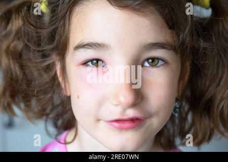 Una palpebra rossa gonfia sul viso di un bambino in primo piano è un'allergia al morso di un insetto. Reazione allergica agli insetti succhiatori di sangue Foto Stock