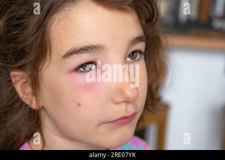 Una palpebra rossa gonfia sul viso di un bambino in primo piano è un'allergia al morso di un insetto. Reazione allergica agli insetti succhiatori di sangue Foto Stock