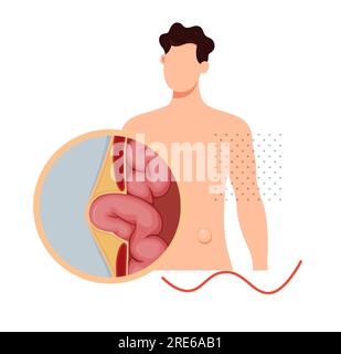 Ernia strangolata - Sezione dell'intestino tenue - Stock Illustration as EPS 10 file Illustrazione Vettoriale