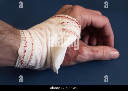 Primo piano di una mano fasciata parzialmente a spirale appoggiata su un tavolo blu, esponendo i resti di ustioni di secondo grado nell'area del pollice. Pronto soccorso e woun Foto Stock