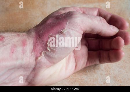 Primo piano di una mano parzialmente bruciata con una bruciatura di secondo grado, che rivela arrossamento, crepe e cambiamenti della consistenza della pelle. Pronto soccorso, guarigione delle ferite. Foto Stock