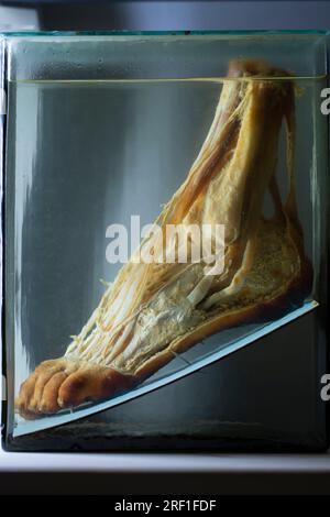1° aprile 2023. Gomel. Mostra di oggetti anatomici. La parte congelata di una gamba umana è presentata come una mostra anatomica conservata nell'alcoho Foto Stock