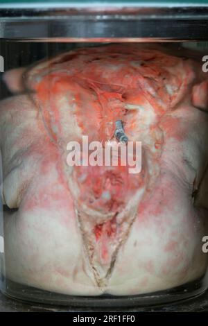 1° aprile 2023. Gomel. Mostra di oggetti anatomici. Neonato umano con sviluppo patologico di non union del canale spinale. Rachioschis. Defe Foto Stock