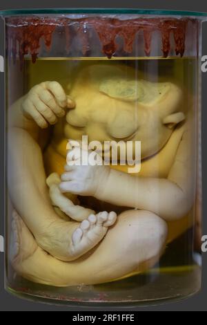 1° aprile 2023. Gomel. Mostra di oggetti anatomici. Un bambino umano con lo sviluppo patologico dell'anencefalia - l'assenza della maggior parte del Foto Stock