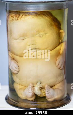 1° aprile 2023 Mostra delle mostre anatomiche. Neonato umano con sviluppo patologico di dropsy. Bambino elefante. Mostre del Museo di Anterno Foto Stock