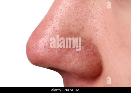 Giovane con problema di acne su sfondo grigio, vista ravvicinata del naso Foto Stock