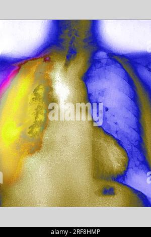 Cancro del polmone (destro), visualizzato da una radiografia toracica AP. Foto Stock