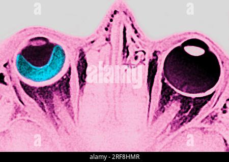 Distacco retinico dell'occhio sinistro, visualizzato mediante RM a sezione radiale. Foto Stock