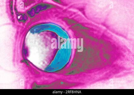 Distacco retinico dell'occhio sinistro, visualizzato mediante RM a sezione radiale. Foto Stock