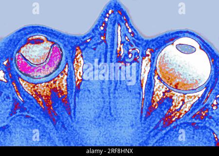 Distacco retinico dell'occhio sinistro, visualizzato mediante RM a sezione radiale. Foto Stock