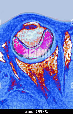 Distacco retinico dell'occhio sinistro, visualizzato mediante RM a sezione radiale. Foto Stock