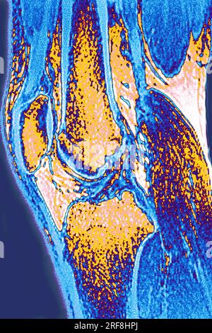 Ginocchio normale visualizzato da RM nella sezione sagittale. Foto Stock