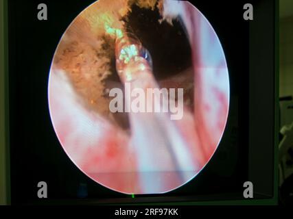 Chirurgia laser per il trattamento dell'iperplasia prostatica benigna, immagine endoscopica. Foto Stock