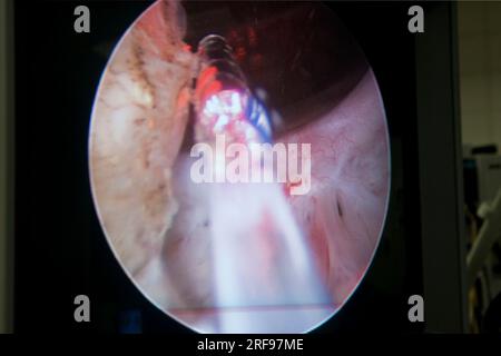 Chirurgia laser per il trattamento dell'iperplasia prostatica benigna, immagine endoscopica. Foto Stock
