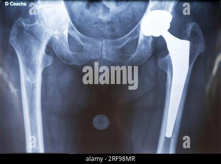 Radiografia di una protesi dell'anca. Foto Stock