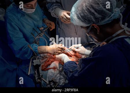 Vista dall'alto del team di chirurghi durante operazioni complesse sulla cavità aperta del corpo del paziente. I medici si sono appoggiati sul paziente utilizzando moderni strumenti chirurgici e. Foto Stock