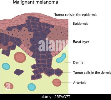 Melanoma maligno. Malattie della pelle. Cancro della pelle Illustrazione Vettoriale