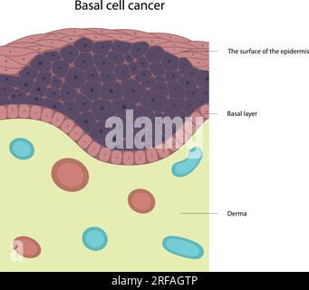 Cancro delle cellule basali. Malattie della pelle. Cellule tumorali. Illustrazione Vettoriale