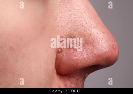 Giovane con problema di acne su sfondo grigio, vista ravvicinata del naso Foto Stock