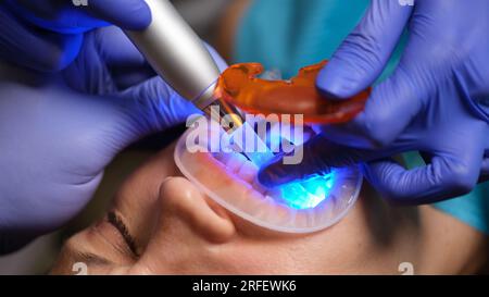 Ripristino dei denti con lampada di riempimento-polimerizzazione Foto Stock